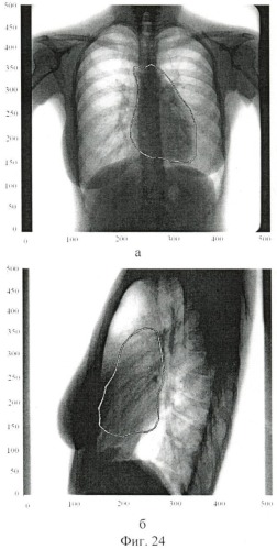Способ определения контура сердца на флюорографических снимках (патент 2478337)