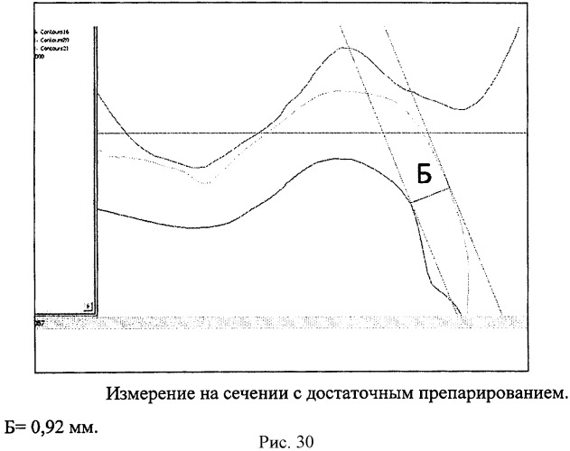 Способ контроля препарирования окклюзионной поверхности зубов при ортопедическом лечении несъемными протезами (патент 2396921)