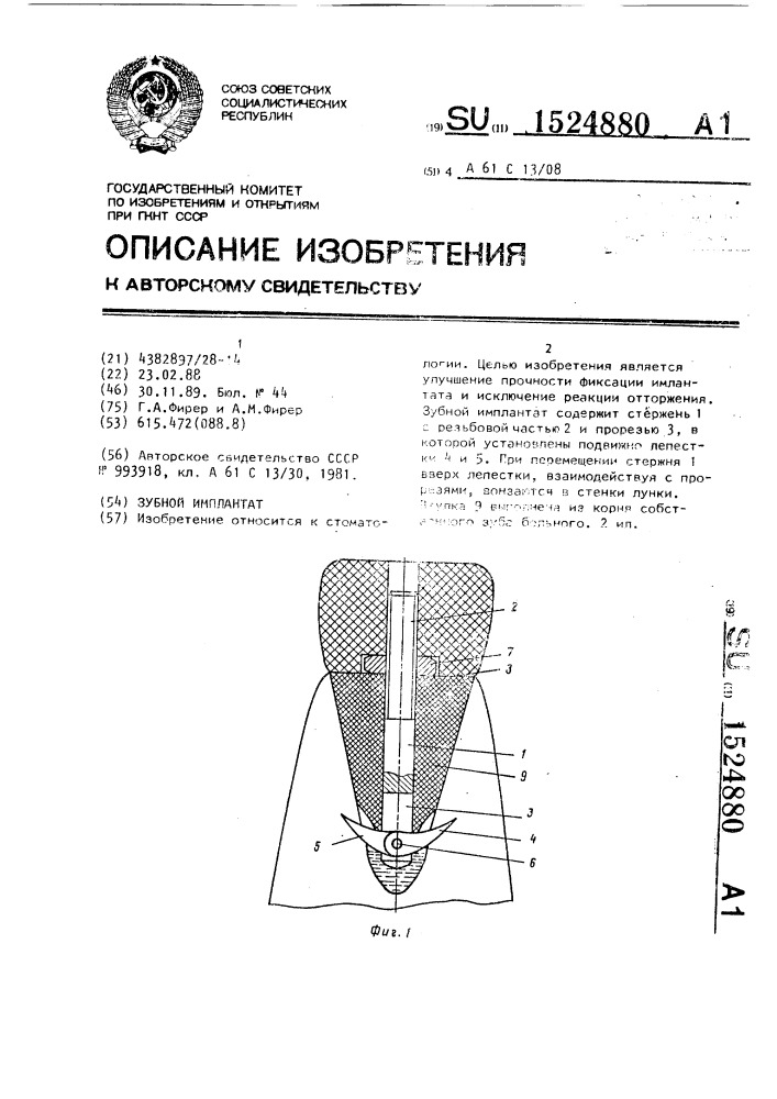 Зубной имплантат (патент 1524880)