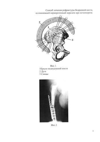 Способ лечения рефрактуры бедренной кости, осложнившей перипротезный перелом при остеопорозе (патент 2585140)