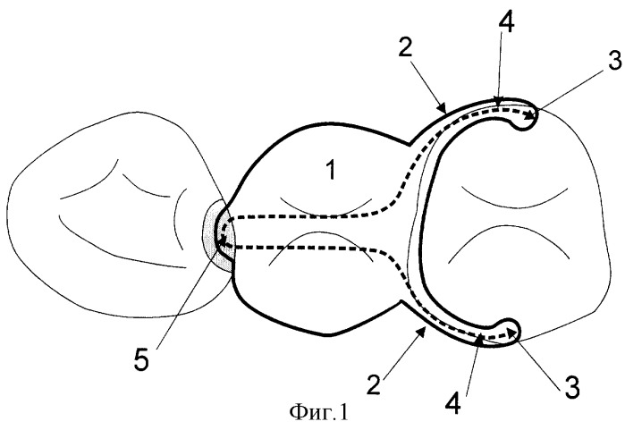 Способ замещения единичного отсутствующего зуба волоконно-композитным несъемным адгезивным мостовидным протезом (патент 2320292)