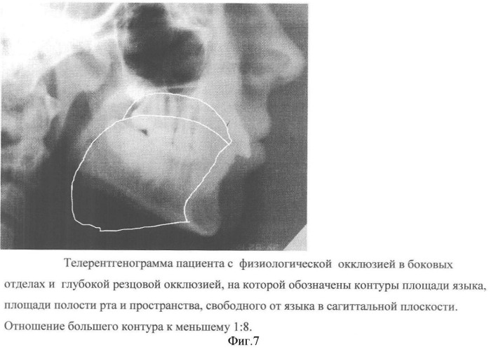 Способ диагностики аномалий зубочелюстной системы (патент 2360604)