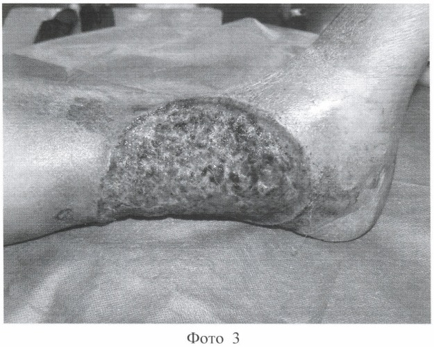 Композиция для лечения гнойных ран и трофических язв (патент 2384338)