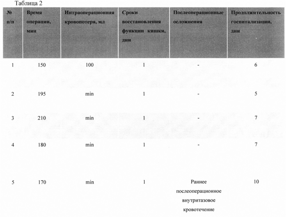 Способ роботической экстралеваторной брюшно-промежностной экстирпации прямой кишки с трансабдоминальным пересечением леваторов в литотомическом положении пациента (патент 2632526)