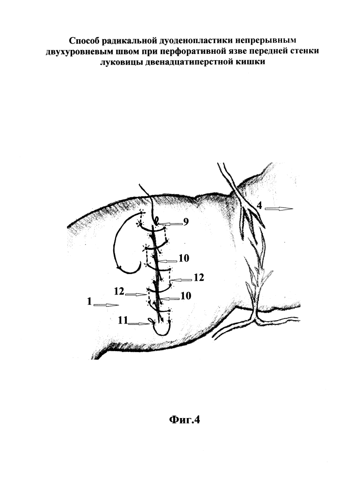 Способ радикальной дуоденопластики непрерывным двухуровневым швом при перфоративной язве передней стенки луковицы двенадцатиперстной кишки (патент 2654272)