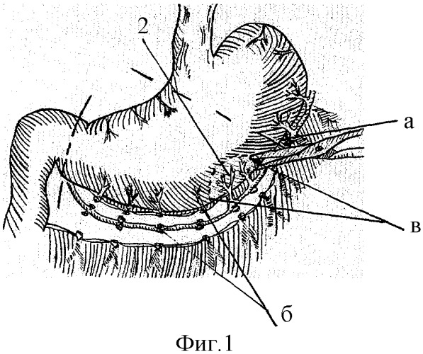Способ укрытия &quot;трудной&quot; культи двенадцатиперстной кишки при резекции желудка по бильрот-ii (патент 2286096)