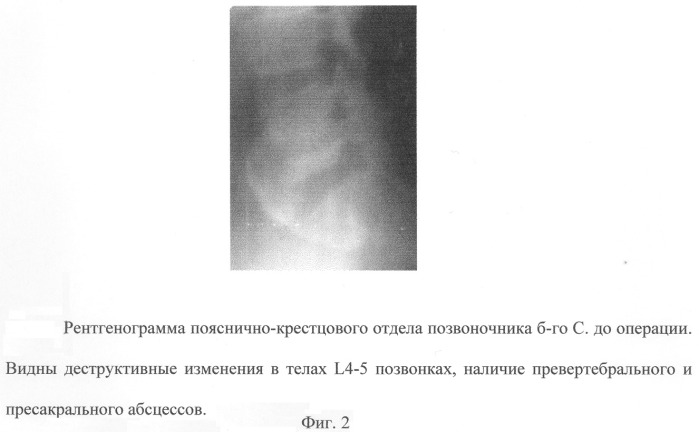 Способ инструментальной фиксации пояснично-крестцового отдела при воспалительных заболеваниях позвоночника (патент 2271165)