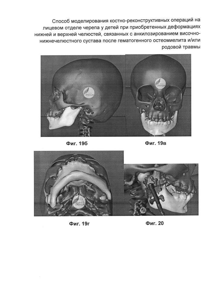 Способ моделирования костно-реконструктивных операций на лицевом отделе черепа у детей при приобретенных деформациях нижней и верхней челюстей, связанных с анкилозированием височно-нижнечелюстного сустава после гематогенного остеомиелита и/или родовой травмы (патент 2604774)