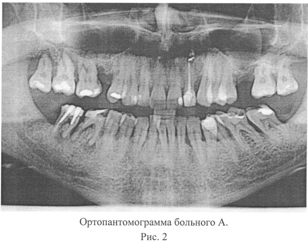 Способ оценки степени тяжести заболевания пародонта (патент 2546102)