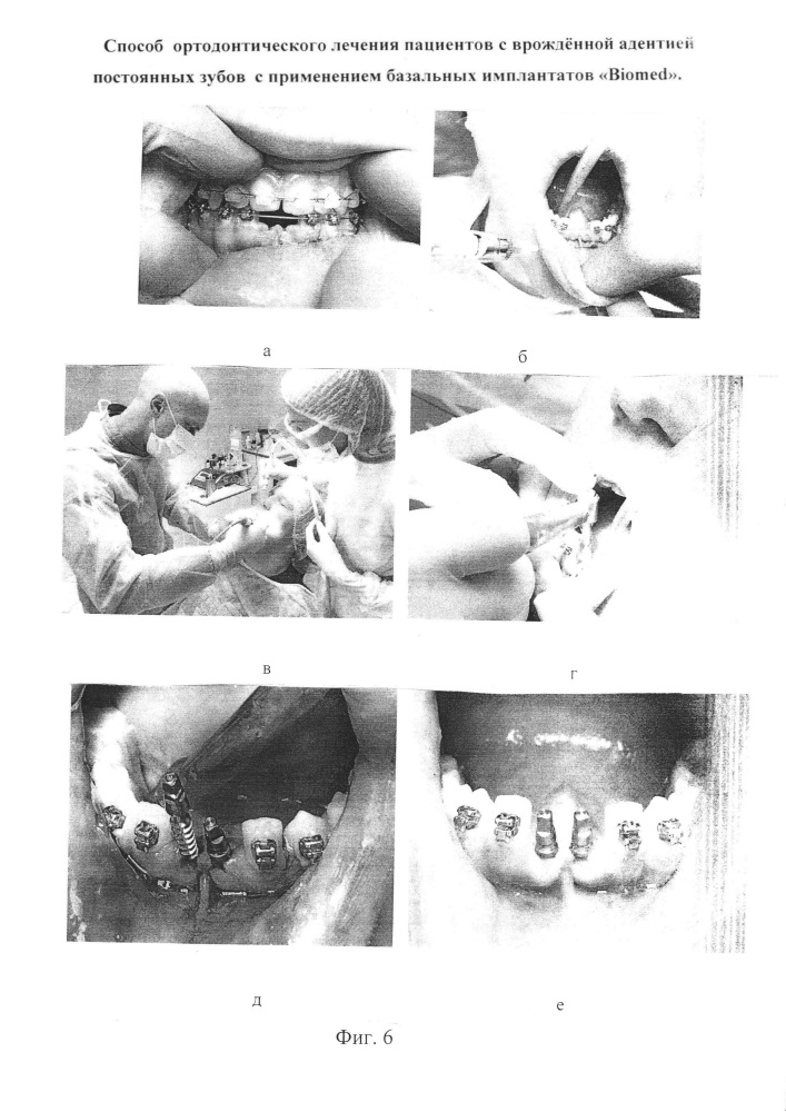 Способ ортодонтического лечения пациентов с врождённой адентией постоянных зубов с применением базальных имплантатов "biomed" (патент 2638286)