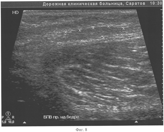 Способ прогнозирования результатов интраоперационной стволовой катетерной склерооблитерации большой подкожной вены бедра у больных с варикозной болезнью нижних конечностей (патент 2545414)