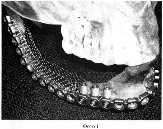 Устройство для устранения дефектов и деформаций кости нижней челюсти (патент 2387410)