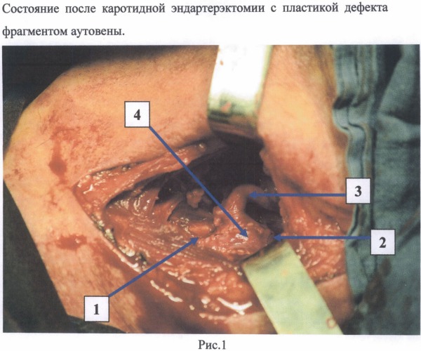 Способ экстравазального армирования сонных артерий при операции каротидной эндартерэктомии (патент 2485897)