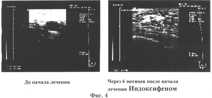 Фармацевтическая композиция для лечения и профилактики пролиферативных заболеваний молочной железы (патент 2318508)