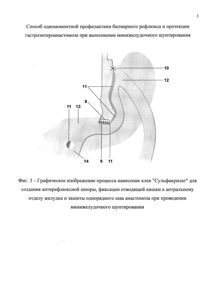Способ одномоментной профилактики билиарного рефлюкса и протекции гастроэнтероанастомоза при выполнении минижелудочного шунтирования (патент 2629045)