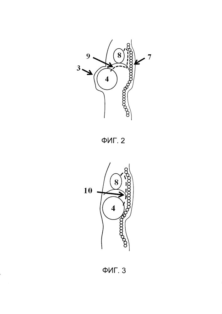 Способ хирургического лечения больших и гигантских вентральных грыж у детей, рожденных с омфалоцеле (патент 2631640)