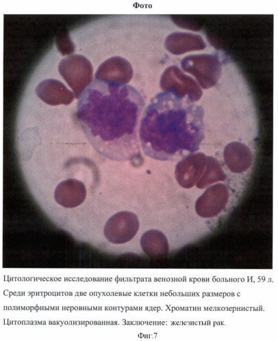 Способ определения раковых клеток в периферической венозной крови у больных с подозрением на злокачественные новообразования (патент 2425385)