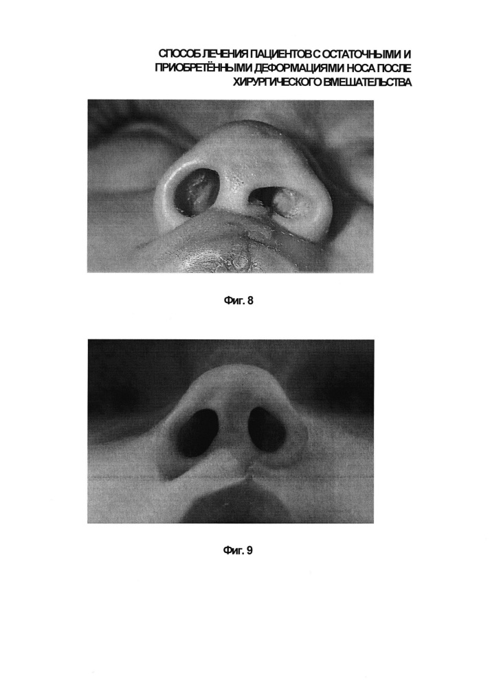 Способ лечения пациентов после хирургического вмешательства, выполненного по поводу остаточных и приобретённых деформаций носа (патент 2630130)