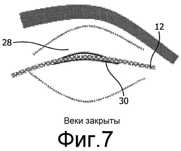 Система для доставки электромагнитного излучения в глазное яблоко субъекта (патент 2567263)