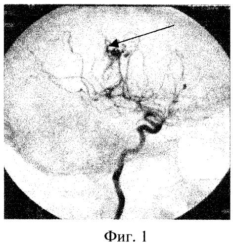 Способ определения приводящего сосуда артериовенозной мальформации головного мозга (патент 2267994)