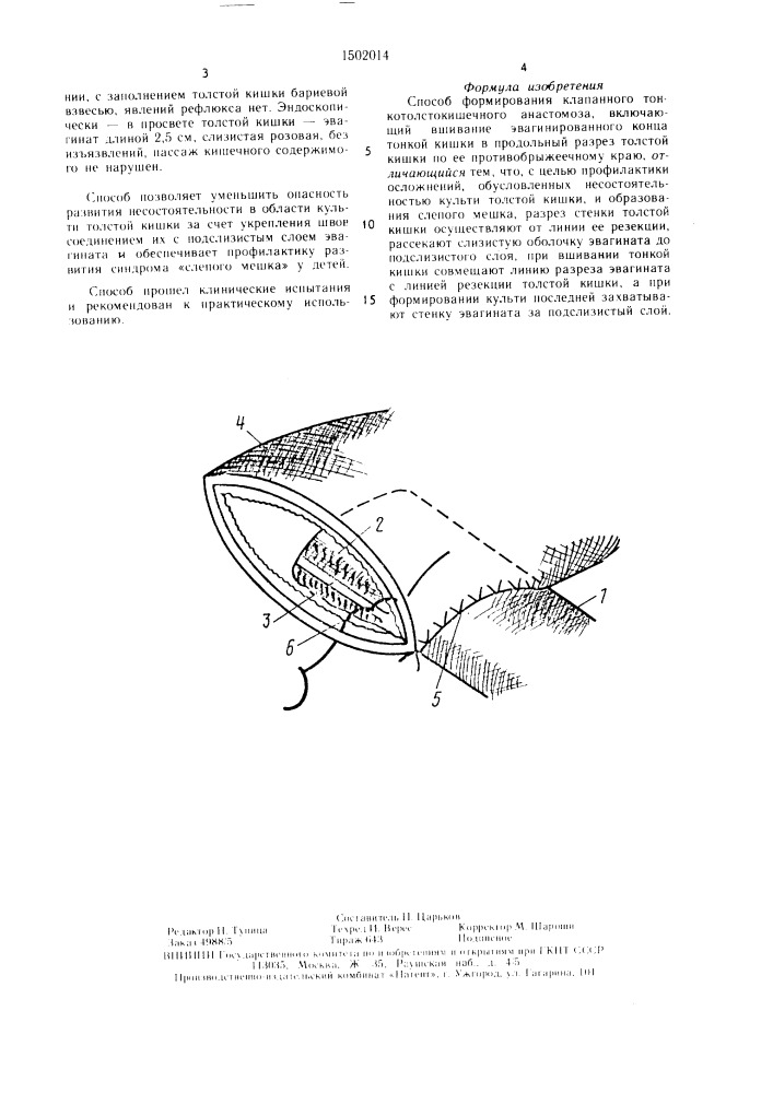 Способ формирования клапанного тонкотолстокишечного анастомоза (патент 1502014)