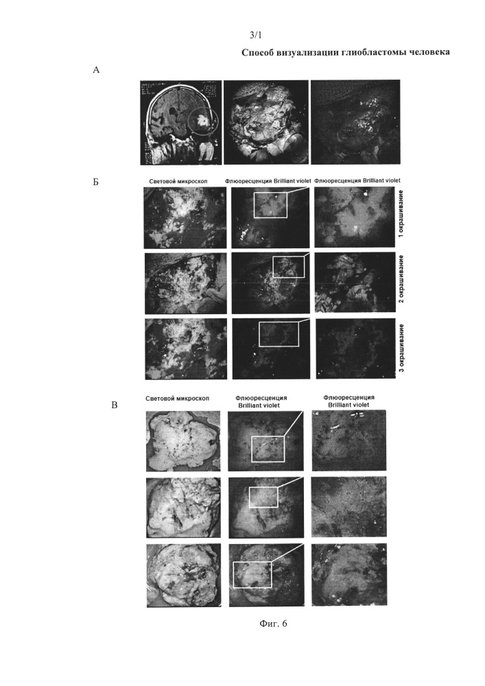 Способ визуализации глиобластомы человека (патент 2654665)