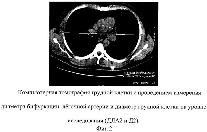 Способ компьютерной диагностики степени легочной гипертензии (патент 2269931)