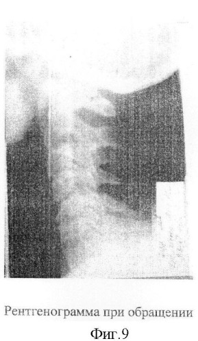 Устройство для лечения патологии шейного отдела позвоночника (патент 2382620)