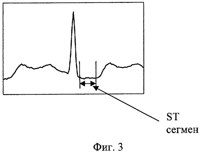 Способ представления электрокардиосигнала (патент 2427314)