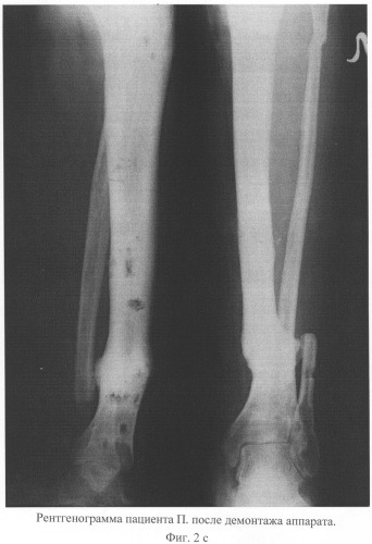 Способ лечения несросшихся переломов и ложных суставов костей голени, осложненных хроническим травматическим остеомиелитом (патент 2311144)