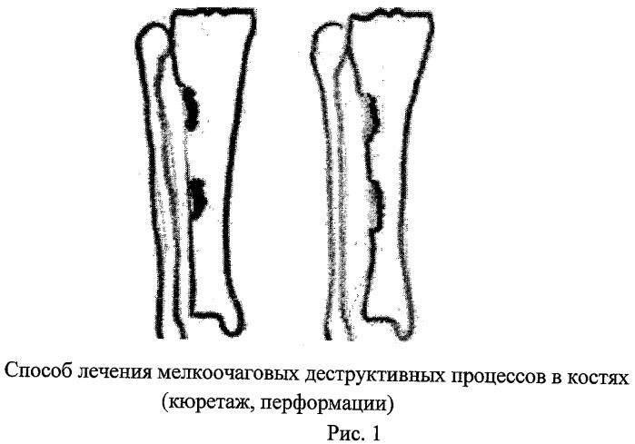 Способ лечения кистозной деструкции кости (патент 2456950)