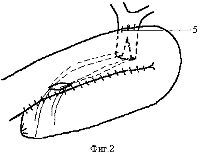 Способ наложения антирефлюксного холедохоэнтероанастомоза (патент 2290101)
