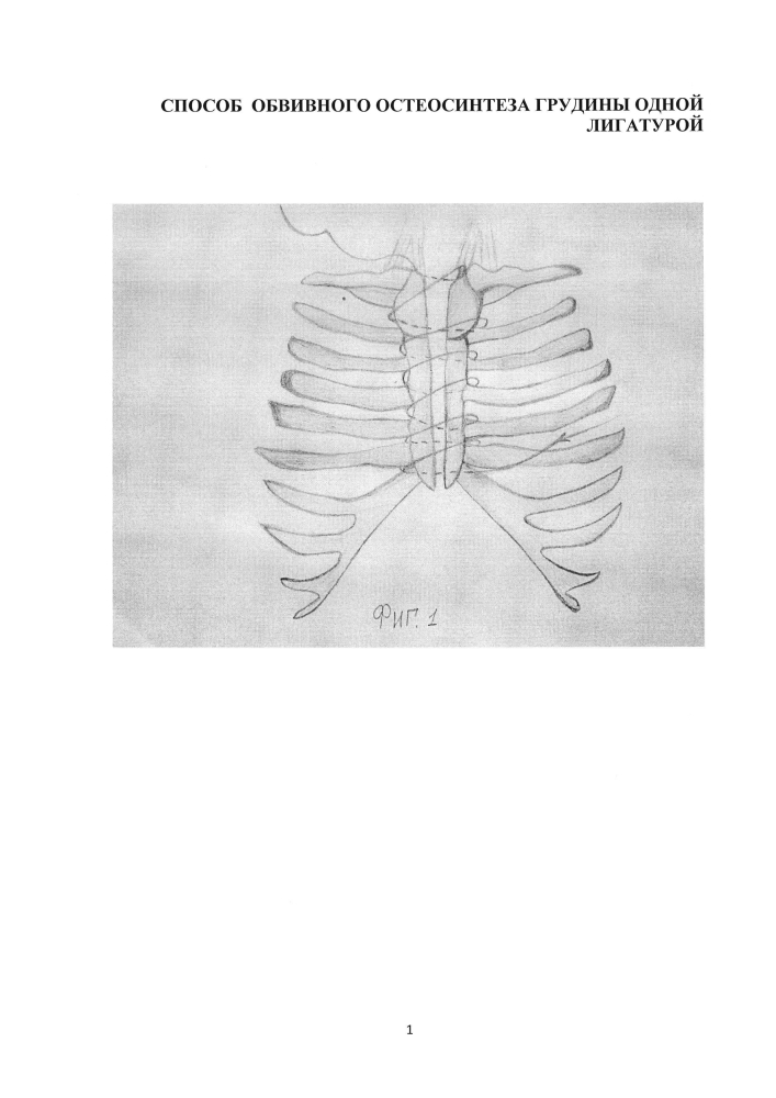 Способ обвивного остеосинтеза грудины одной лигатурой (патент 2598123)