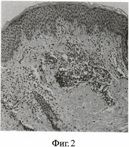 Способ дифференциальной диагностики лимфопролиферативных заболеваний кожи по морфометрическому профилю базальных кератиноцитов (патент 2476879)
