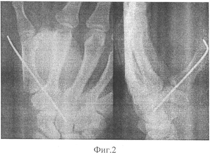 Способ лечения привычного вывиха первого запястно-пястного сустава (патент 2336840)