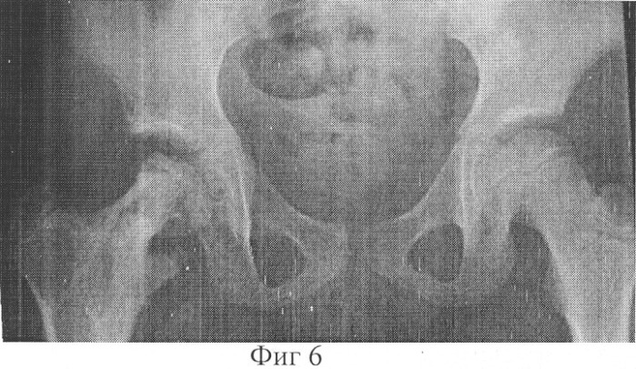 Способ лечения деформации проксимального отдела бедра (патент 2256423)