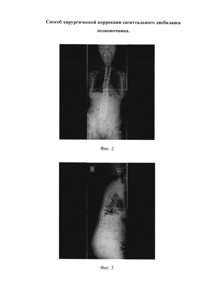 Способ хирургической коррекции сагиттального дисбаланса позвоночника (патент 2629328)