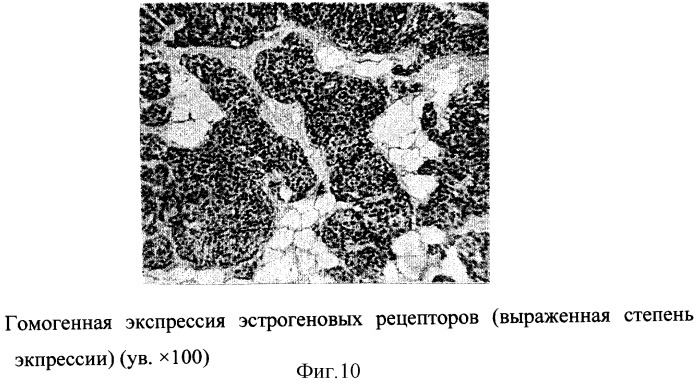 Способ прогнозирования течения заболевания раком молочной железы (патент 2300111)