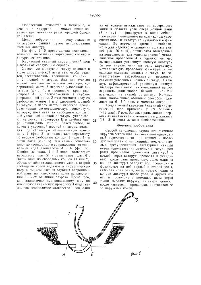 Способ наложения каркасного съемного хирургического шва (патент 1426555)