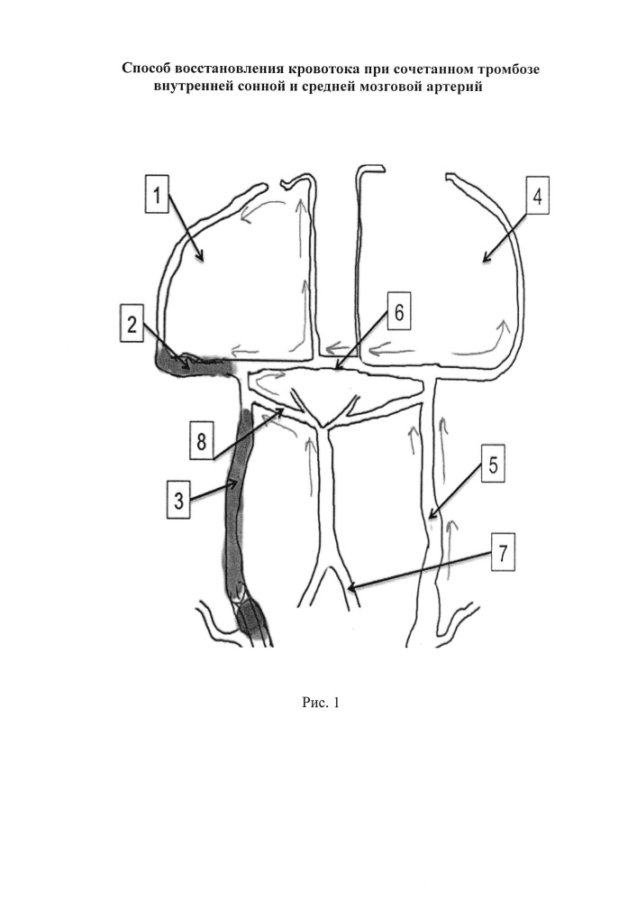 Способ восстановления кровотока при сочетанном тромбозе внутренней сонной и средней мозговой артерий (патент 2629046)