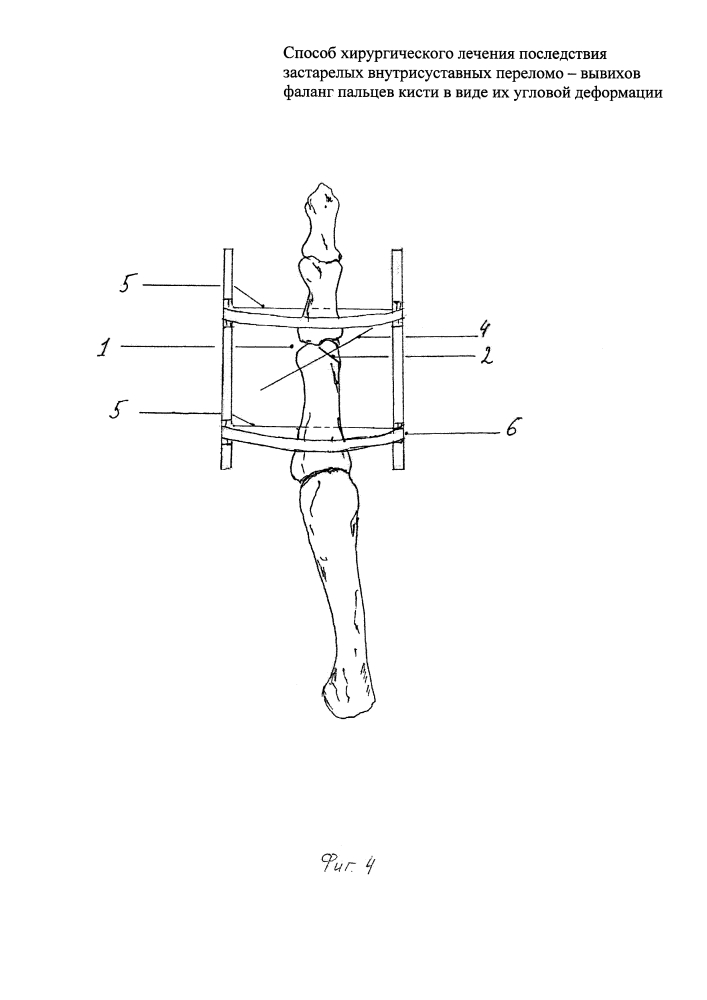 Способ хирургического лечения последствия застарелых внутрисуставных переломо-вывихов фаланг пальцев кисти в виде их угловой деформации (патент 2612588)