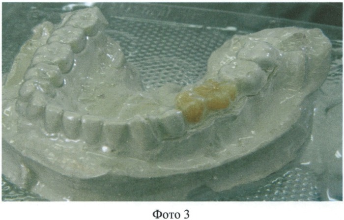 Способ изготовления временного зубного протеза (патент 2531445)