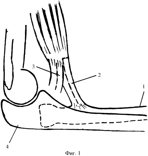 Способ открытого вправления головки лучевой кости при ее заднем вывихе у детей (патент 2328995)