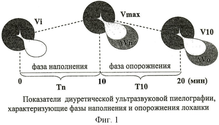 Способ диагностики нарушений уродинамики расширенной лоханки у детей с гидронефрозом (патент 2423918)