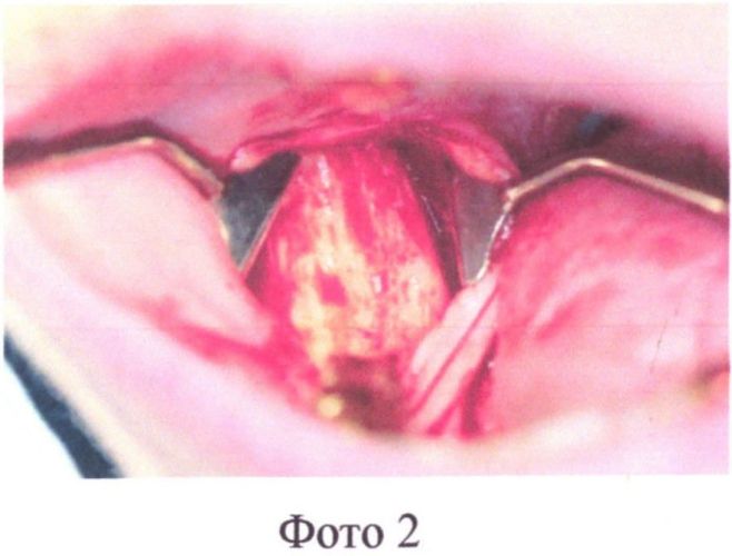 Способ пластики альвеолярного отростка верхней челюсти при его атрофии (патент 2563367)