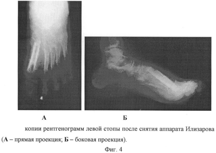 Способ оперативного лечения больных с субтотальным дефектом плюсневой кости и плоскостопием (патент 2412662)