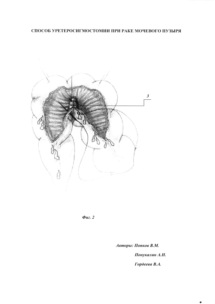 Способ уретеросигмостомии при раке мочевого пузыря (патент 2612189)