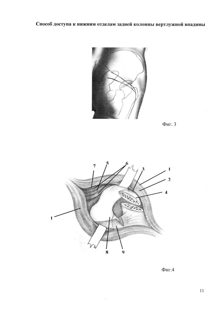 Способ доступа к нижним отделам задней колонны вертлужной впадины (патент 2624387)