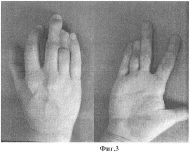 Способ кожно-костной реконструкции пальца кисти (патент 2482803)