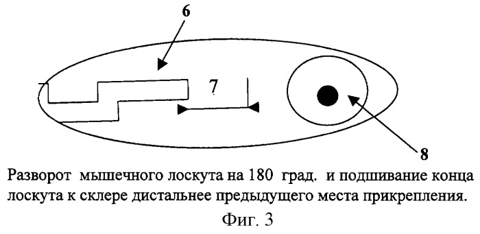 Способ лечения больших углов косоглазия (патент 2243750)